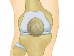 膝关节是易碎品！三信号说明膝关节在求救