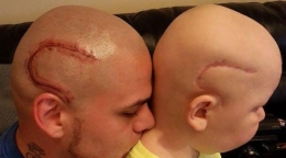 患癌男孩手术后留疤 老爸纹同样图案激励儿子