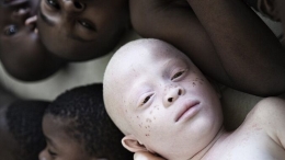 女摄影师拍非洲白化病患呼吁破除迷信
