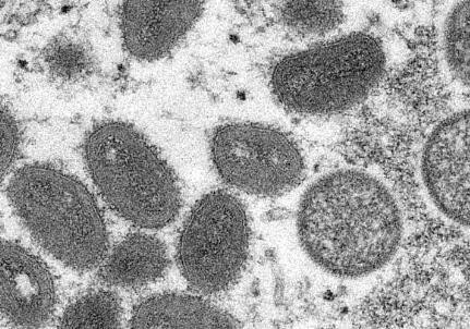 韩国将猴痘列为乙类传染病 感染者需隔离