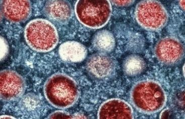外媒：乌克兰出现首例猴痘确诊病例 患者症状轻微