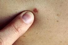 澳研究发现：皮肤癌可能潜伏在正常皮肤中