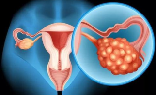 卵巢癌死亡率居妇科之首 定期筛查不容忽视