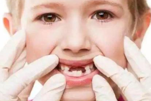 孩子换牙期间会遇到哪些情况？该如何处理