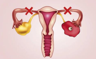 如何治疗输卵管堵塞？输卵管堵塞吃什么药能通