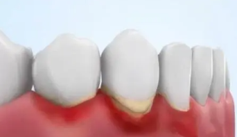 治疗牙周炎的方法有哪些？3类人易患牙周炎