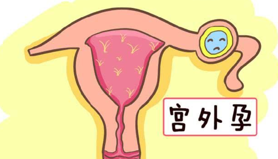 为什么很多女性会出现宫外孕？与这5大因素有关