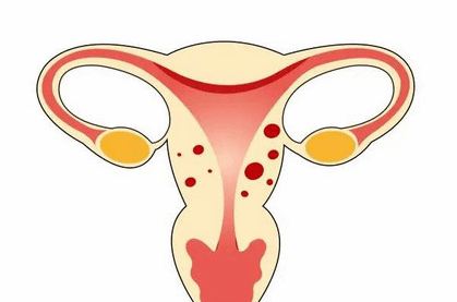 子宫内膜异位症的这5大症状 早发现早治疗