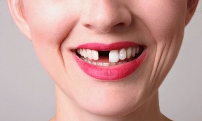 缺牙不仅影响美观和咀嚼功能 还会增加痴呆风险