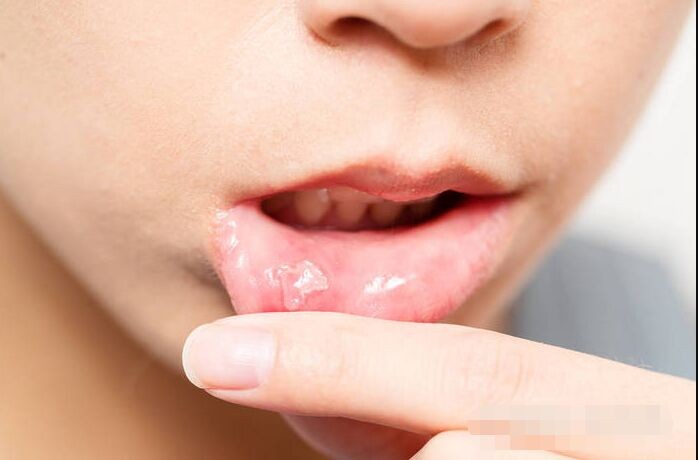 这5种坏习惯会导致口腔溃疡 你中招了吗
