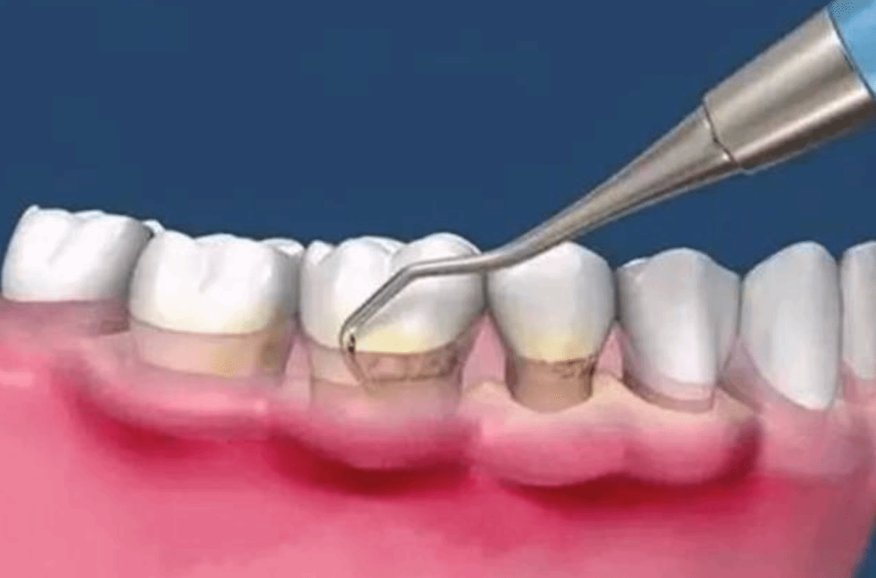牙周炎是怎么导致的？可能与这6个坏习惯有关