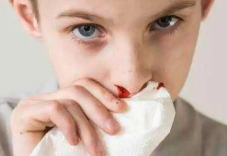 小儿容易流鼻血是怎么回事？可能是这3种原因