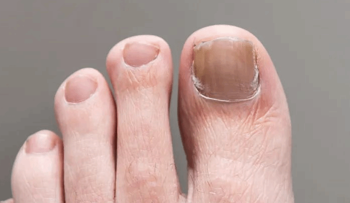 指甲变灰就是得了灰指甲？真正的灰指甲有这些症状