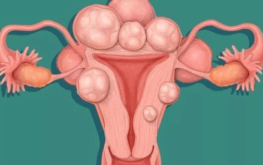 子宫肌瘤为何年轻化？发现子宫肌瘤后需要做手术吗