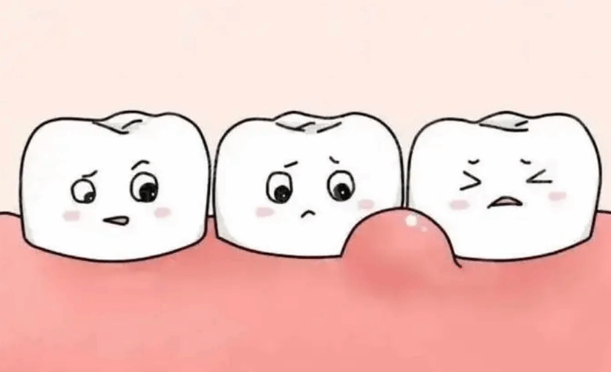 关注儿童口腔健康：孩子牙龈鼓包 警惕根尖周炎