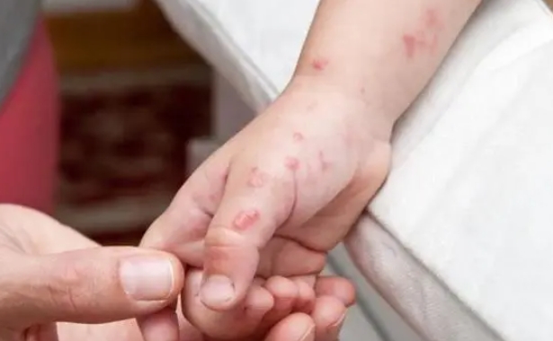 传染性强、人群普遍易感 水痘高发期如何防