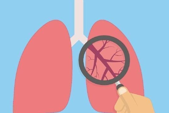 你知道关于肺癌的这些常识吗？来看专家讲解