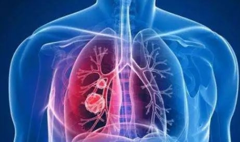 早发现早治疗有效提高肺癌生存率 肺结节你了解吗