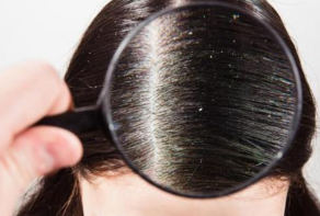人为什么会有头皮屑 7种方法教你护理头发