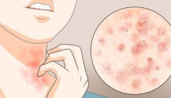 皮肤出现这三种症状 要警惕是螨虫性皮炎