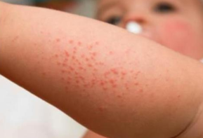 孩子冬季“湿疹”频发 如何避免特应性皮炎