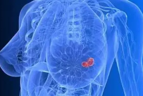 乳腺增生早期有2症状 乳腺增生结节会癌变吗