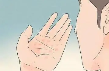 手部皮肤出现了这三种症状 要小心是手癣