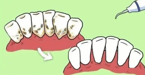 每年进行口腔检查至少洁牙一次 维持口腔健康
