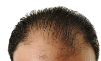 年轻人焦虑到“头秃”？如何科学认识发际线