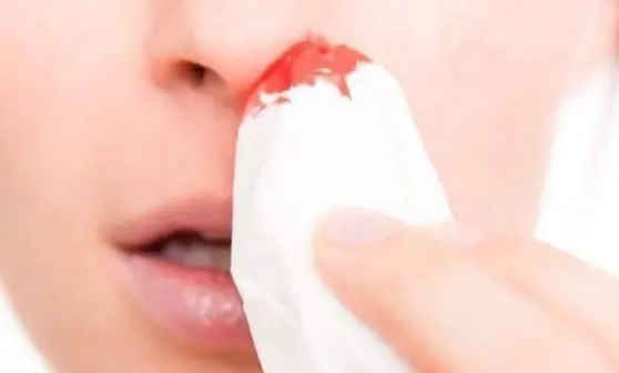 6岁孩子习惯性鼻出血 竟是频繁挖鼻孔惹的祸